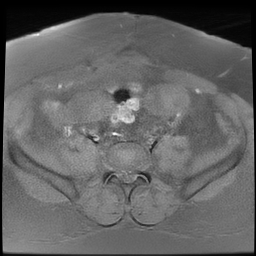 File:Adenomyosis within a didelphys uterus (Radiopaedia 70175-80215 Axial T1 fat sat 15).jpg