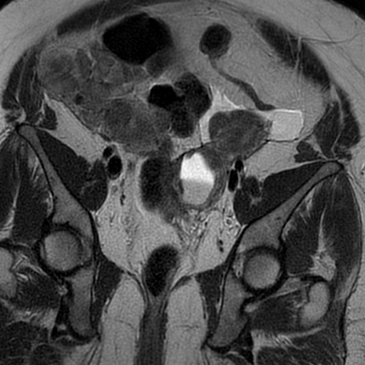 File:Adenomyosis within a didelphys uterus (Radiopaedia 70175-80215 Coronal T2 18).jpg