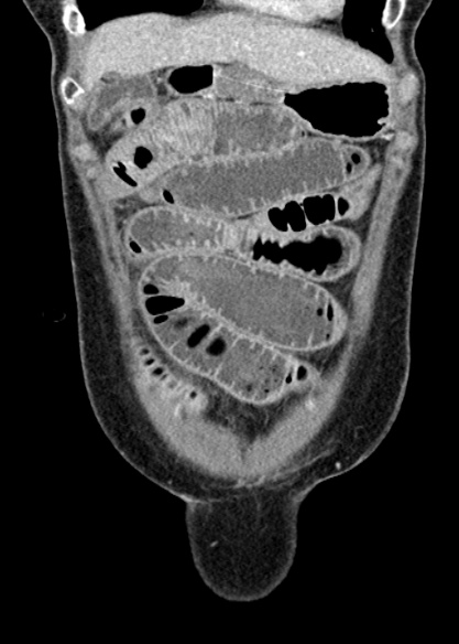 Adhesional small bowel obstruction (Radiopaedia 48397-53305 Coronal C+ portal venous phase 69).jpg