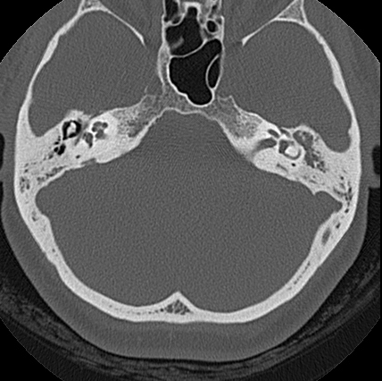 File:Adhesive chronic otitis media (Radiopaedia 14270-14148 Axial bone window 5).jpg