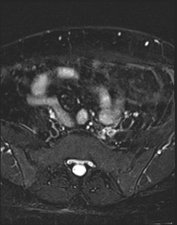 File:Adnexal multilocular cyst (O-RADS US 3- O-RADS MRI 3) (Radiopaedia 87426-103754 Axial T2 fat sat 3).jpg