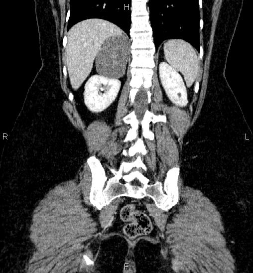 Adrenal cortical carcinoma (Radiopaedia 84882-100379 Coronal C+ portal venous phase 49).jpg