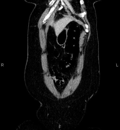 Adrenal cortical carcinoma (Radiopaedia 84882-100379 Coronal C+ portal venous phase 5).jpg