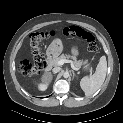 File:Adrenal cyst (Radiopaedia 45625-49777 Axial C+ portal venous phase 36).png