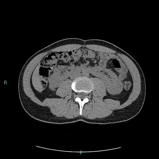 Adrenal cystic lymphangioma (Radiopaedia 83161-97534 Axial non-contrast 50).jpg