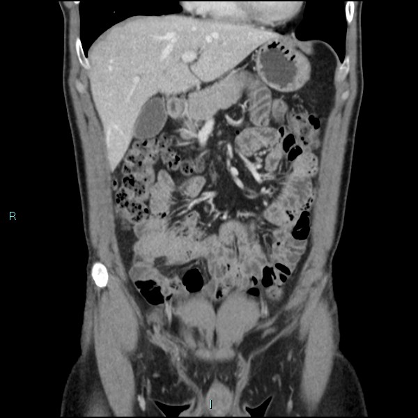 Adrenal cystic lymphangioma (Radiopaedia 83161-97534 Coronal C+ portal venous phase 24).jpg