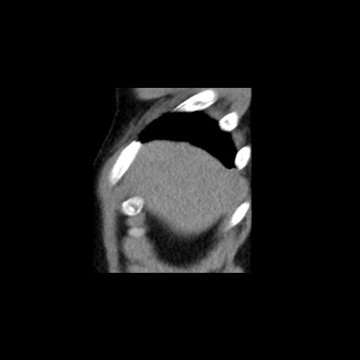 File:Adrenal gland trauma (Radiopaedia 81351-95079 Sagittal non-contrast 7).jpg