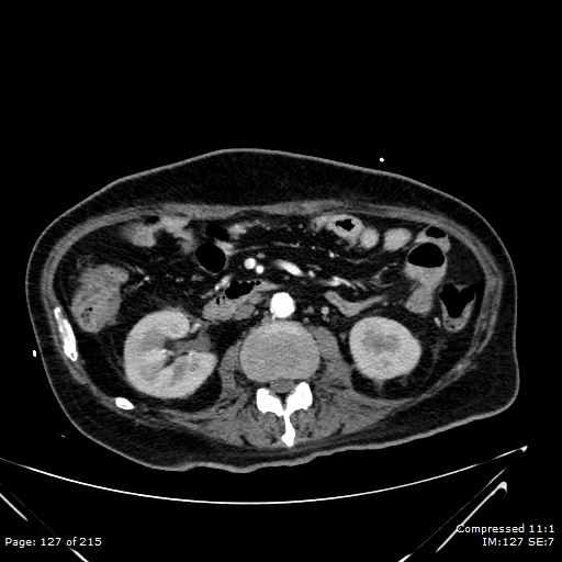 Adrenal metastasis (Radiopaedia 78425-91079 Axial C+ arterial phase 57).jpg