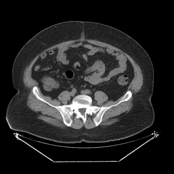 Adrenal myelolipoma (Radiopaedia 26278-26407 Axial non-contrast 51).jpg