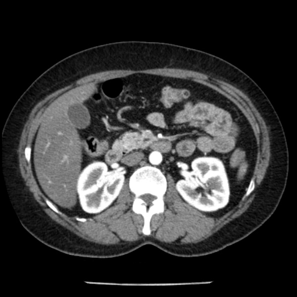 Adrenal myelolipoma (Radiopaedia 43401-46759 Axial C+ arterial phase 41).jpg