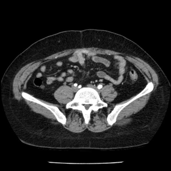 Adrenal myelolipoma (Radiopaedia 43401-46759 Axial C+ arterial phase 72).jpg