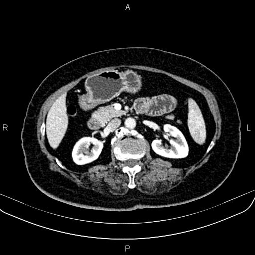 File:Adrenal myelolipoma (Radiopaedia 82742-96986 Axial renal cortical phase 72).jpg