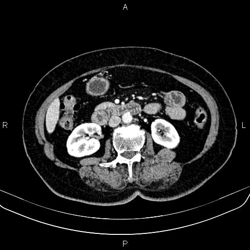 File:Adrenal myelolipoma (Radiopaedia 82742-96986 Axial renal cortical phase 84).jpg