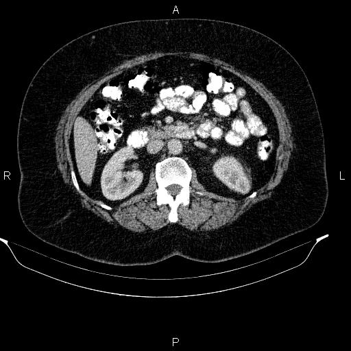 Adrenal myelolipoma (Radiopaedia 84319-99617 Axial renal cortical phase 51).jpg