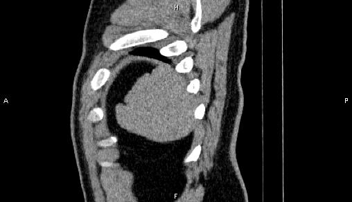 File:Adrenal myelolipoma (Radiopaedia 84321-99619 Sagittal non-contrast 102).jpg
