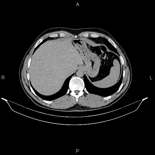 Adrenal myelolipoma (Radiopaedia 87794-104246 Axial renal excretory phase 16).jpg