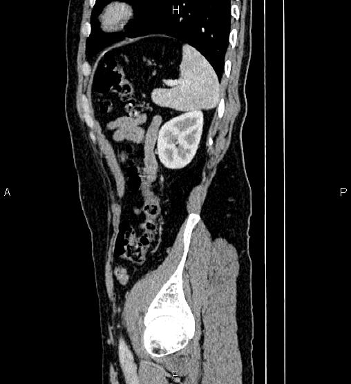 Adrenal myelolipoma (Radiopaedia 87794-104246 Sagittal renal cortical phase 77).jpg