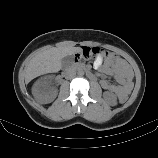 File:Adrenal myelolipoma - bilateral (Radiopaedia 74805-85810 Axial non-contrast 35).jpg