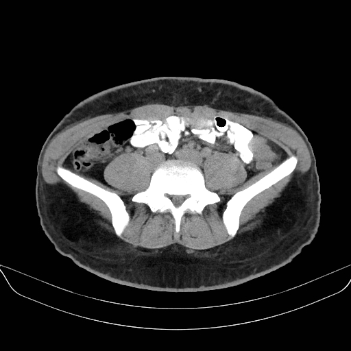 Adrenal myelolipoma - bilateral (Radiopaedia 74805-85810 Axial non-contrast 53).jpg