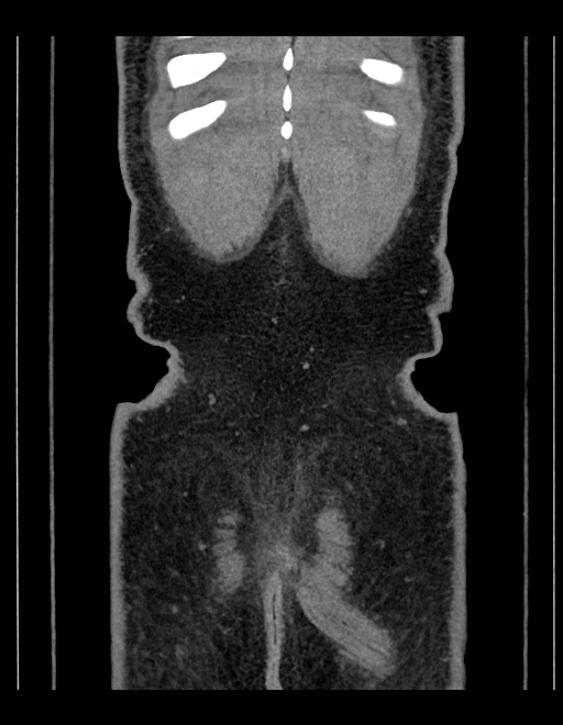 Adrenal myelolipoma - bilateral (Radiopaedia 74805-85810 Coronal C+ portal venous phase 44).jpg
