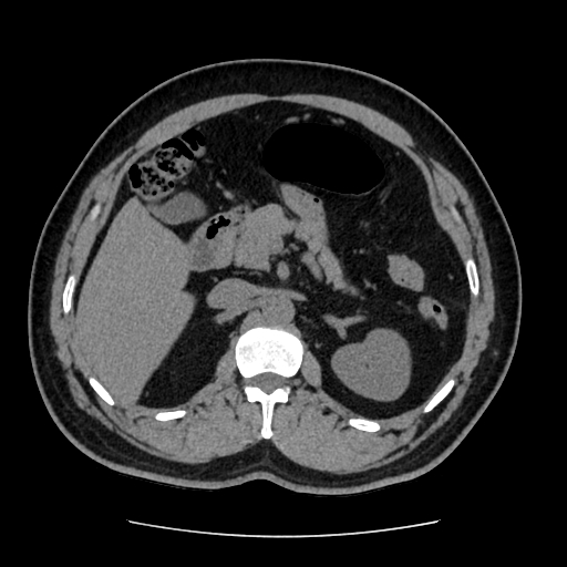 Adrenal myelolipoma and beaver tail liver (Radiopaedia 86201-102193 Axial non-contrast 167).jpg