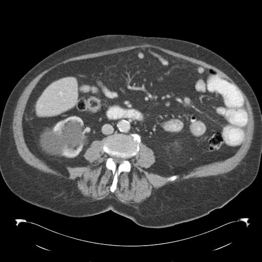 Adult ileal intussusception with secondary obstruction (Radiopaedia 30395-31051 Axial C+ portal venous phase 42).jpg