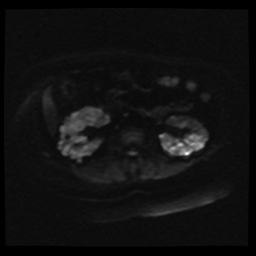 Adult polycystic kidney disease (Radiopaedia 59075-66365 Axial DWI 15).jpg