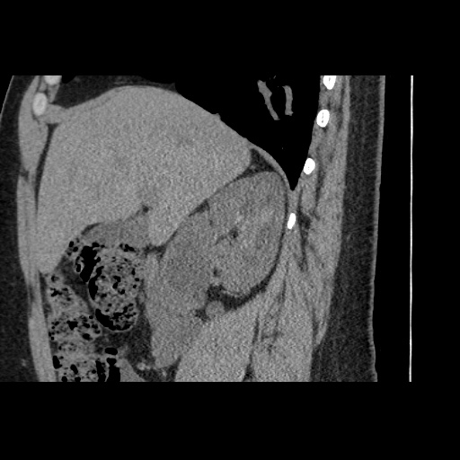 Adult polycystic kidney disease (Radiopaedia 59075-66368 Sagittal non-contrast 24).jpg