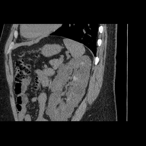 Adult polycystic kidney disease (Radiopaedia 59075-66368 Sagittal non-contrast 67).jpg