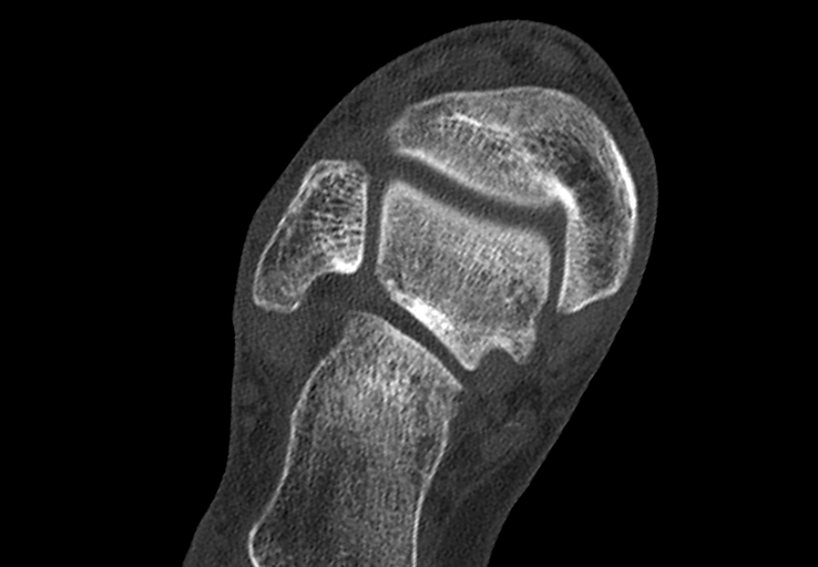Advanced osteomyelitis due to open metatarsal fracture (Radiopaedia 83891-99095 Axial bone window 4).jpg