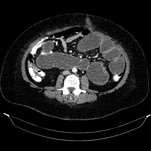 Afferent loop syndrome - secondary to incarcerated trocar site hernia (Radiopaedia 82959-97305 Axial C+ portal venous phase 127).jpg