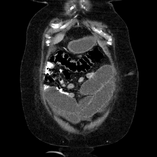 File:Afferent loop syndrome - secondary to incarcerated trocar site hernia (Radiopaedia 82959-97305 Coronal C+ portal venous phase 39).jpg