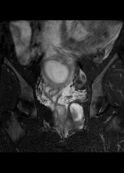 File:Aggressive angiomyxoma of the pelvis and perineum (Radiopaedia 59162-66479 Coronal T2 fat sat 15).jpg