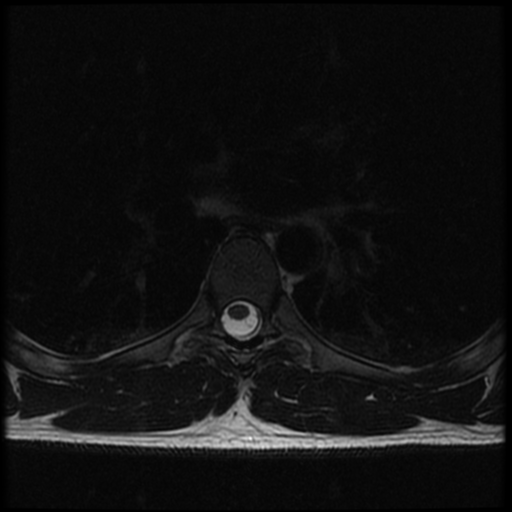 File:Aggressive vertebral hemangioma (Radiopaedia 39937-42404 Axial T2 24).png
