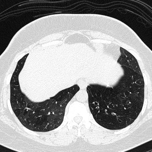Air trapping in small airway disease (Radiopaedia 61685-69694 Axial lung window 154).jpg