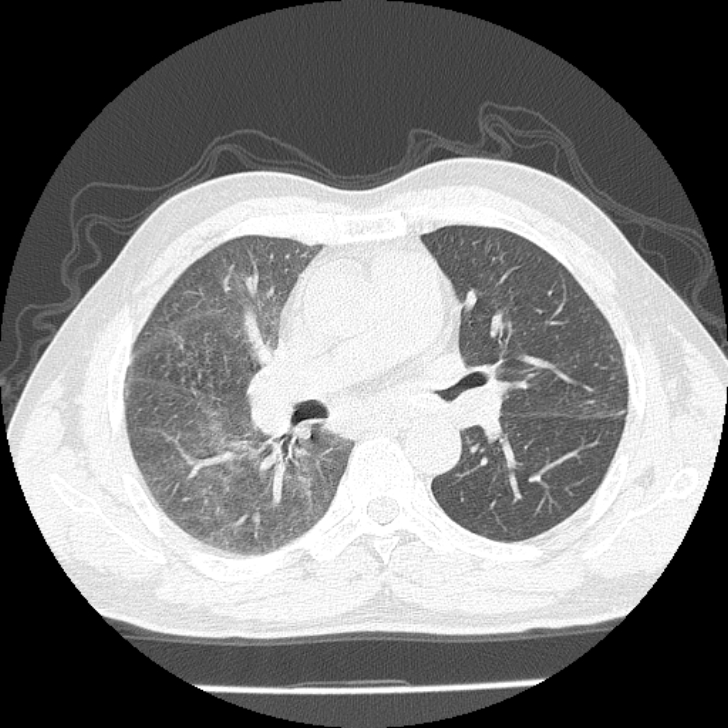 Airway foreign body in adult (Radiopaedia 85907-101779 Axial lung window 74).jpg