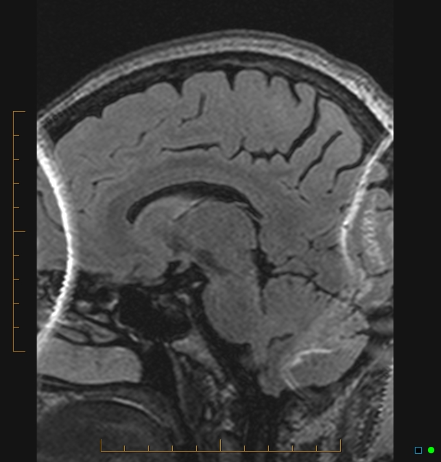 Aliasing artifact causing a spurious cerebellar lesion (Radiopaedia 48783-53810 Sagittal FLAIR 59).jpg