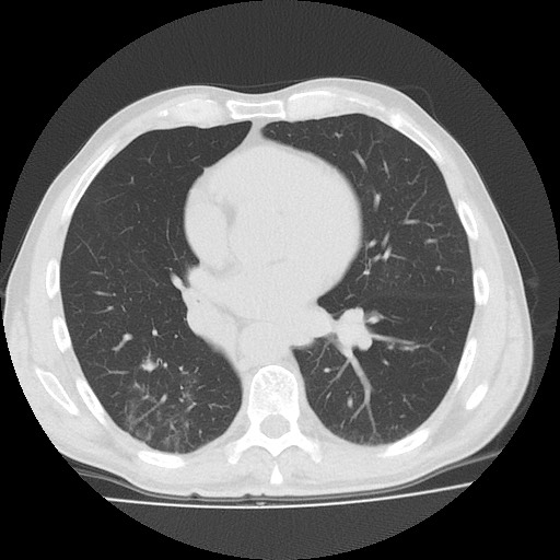 File:Allergic bronchopulmonary aspergillosis (ABPA) (Radiopaedia 60594-68313 Axial lung window 35).jpg