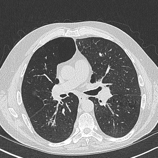 Allergic bronchopulmonary aspergillosis (Radiopaedia 44760-48571 Axial lung window 32).png
