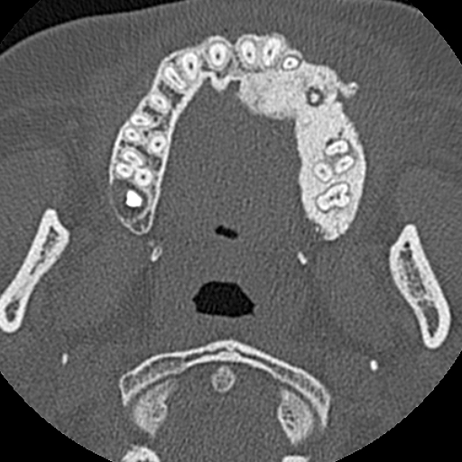 File:Ameloblastic fibro-odontoma (Radiopaedia 18843-18780 C 44).jpg