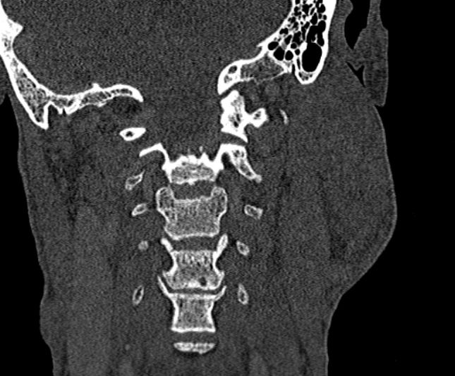 Ameloblastoma (Radiopaedia 51921-57766 Coronal bone window 240).jpg