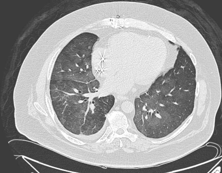 Amiodarone lung (Radiopaedia 62514-70769 Axial lung window 58).jpg