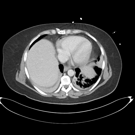 File:Amoebic liver abscess (Radiopaedia 52611-58530 A 11).png