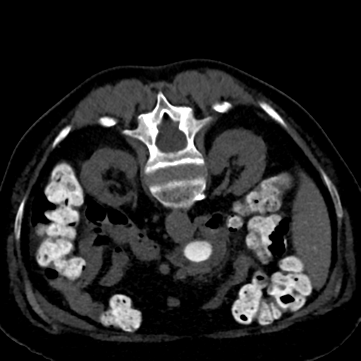 Ampullary adenocarcinoma (Radiopaedia 34013-35241 C 46).png