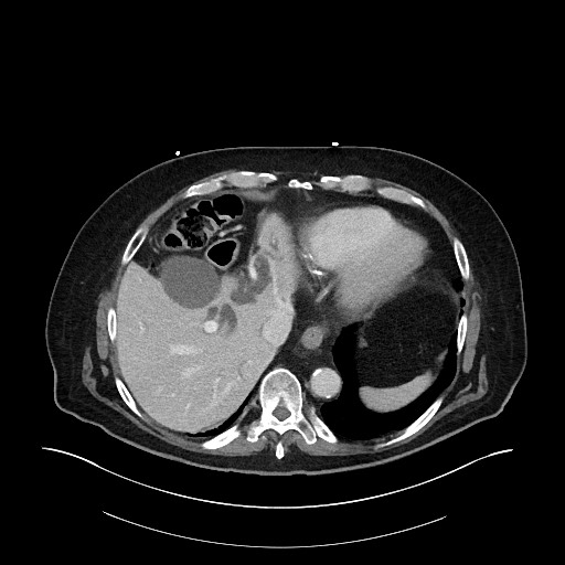 Ampullary adenocarcinoma (Radiopaedia 59373-66734 C 32).jpg