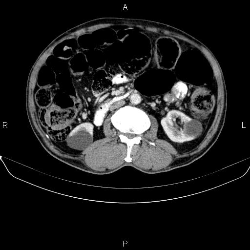 Ampullary adenocarcinoma (Radiopaedia 86093-102032 A 29).jpg