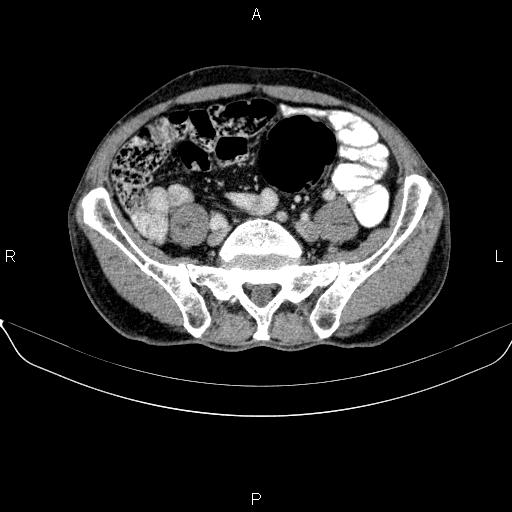 File:Ampullary adenocarcinoma (Radiopaedia 86093-102032 A 42).jpg