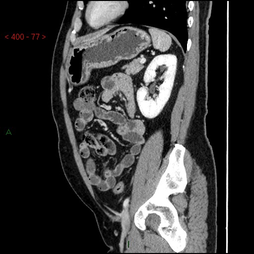 Ampullary carcinoma (Radiopaedia 56396-63056 D 76).jpg