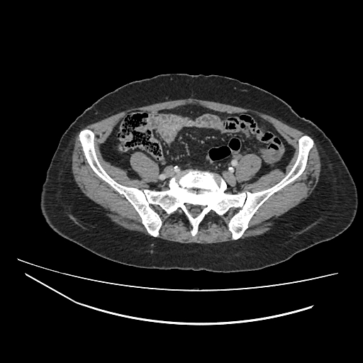 File:Ampullary tumor (Radiopaedia 60333-67998 A 65).jpg