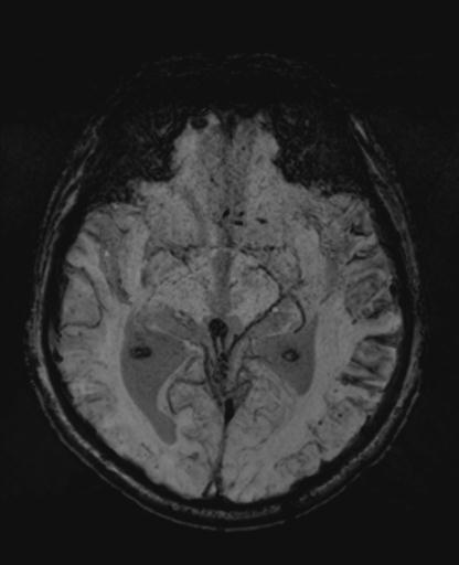 File:Amyloid angiopathy with inflammation (Radiopaedia 30360-31002 Axial SWI MIP 23).jpg